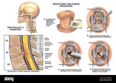 Cervical Fusion Surgery: Effective Relief for Neck Pain Sufferers