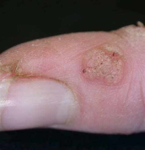 cervical hpv from finger wart