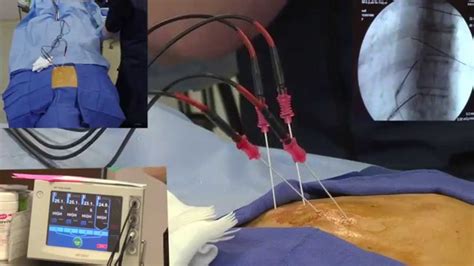 cervical radiofrequency ablation reviews