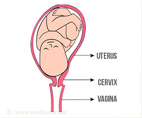 cervical ripening meaning