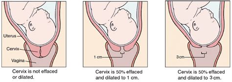 cervix dilated to 3cm