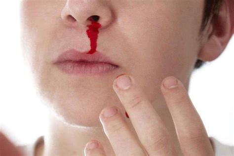 chảy máu mũi là bệnh gì