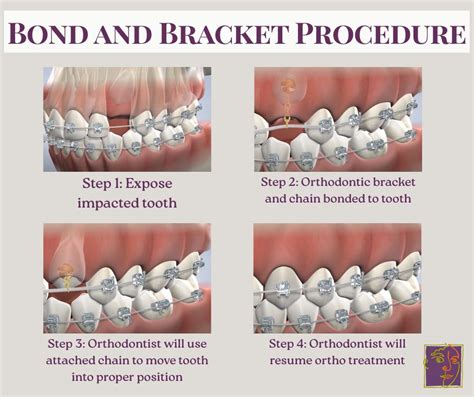 Chain And Bracket Procedure
