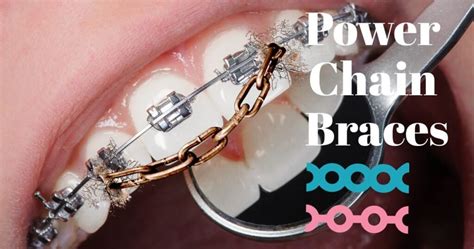 Chains Braces For Teeth