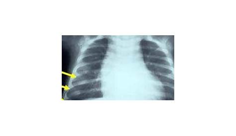 Chapelet Costal Traumatique Pneumothorax