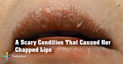 Chapped Lips And Kidney Disease