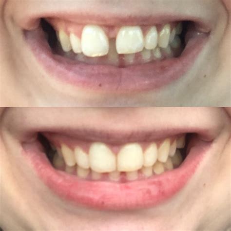 Chapped Lips Invisalign