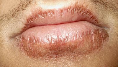 Chapped Lips Itchy