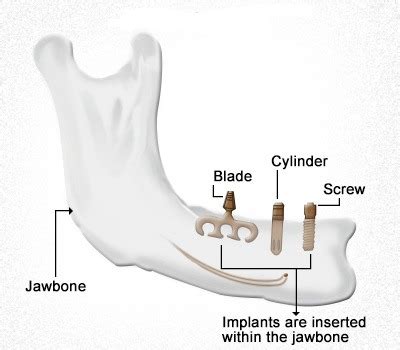 chapter 53 dental implants quizlet