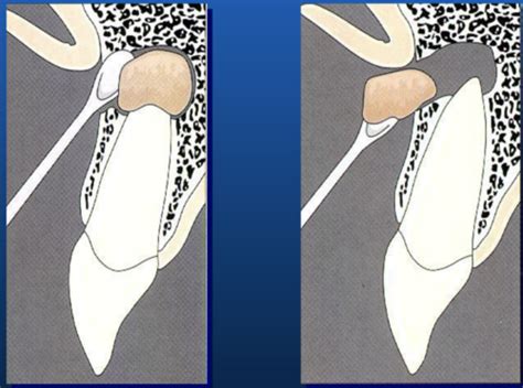 Chapter 54 Endodontics Quizlet