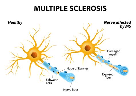 characteristic of multiple sclerosis
