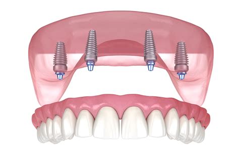 cheap dental implants ny