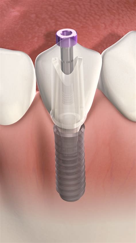cheap dental implants okc