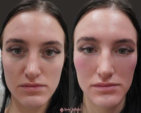 cheek filler for under eye before and after