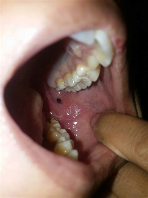 Cheek Keeps Getting Caught In Teeth