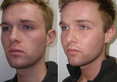 cheekbone implants before and after men