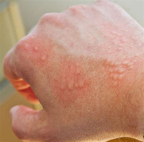 ACD AZ of Skin Irritant contact dermatitis (ICD)