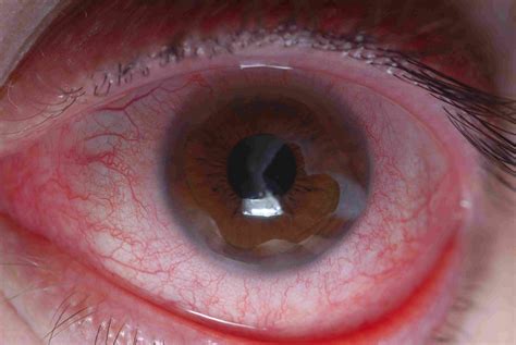 Ocular Chemical Burns Secondary to Unintentional Instillation of Aqua