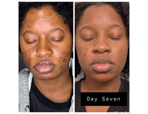 CHEMICAL PEEL ON DARK SKIN WAS IT A MISSTAKE? YouTube