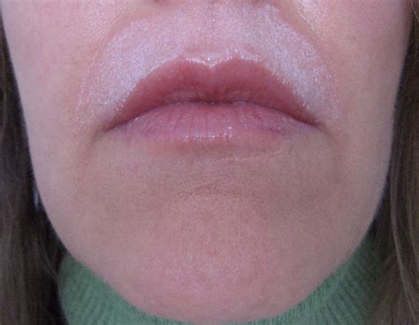 Chemical Peels for Acne and Anti Aging Above Lip Vertical Lines the