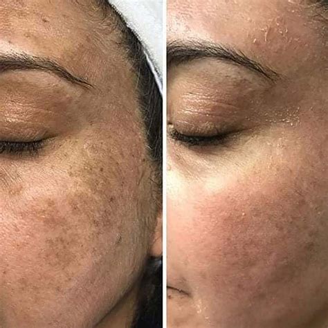 CHEMICAL PEEL FULL PROCESS BEFORE & AFTER HYPERPIGMENTATION/ACNE ON