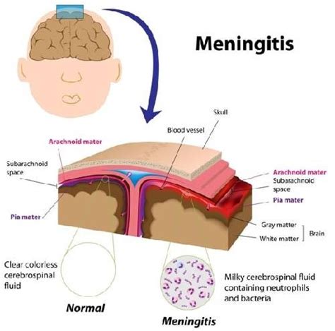 chemical meningitis wiki