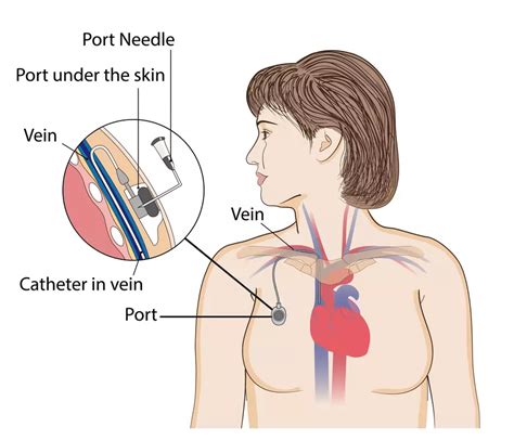 Understanding Chemo Port Placement: A Vital Cancer Treatment Step