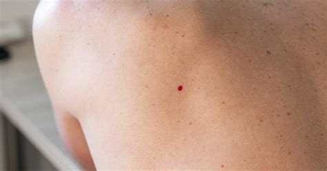 Cherry Angioma Que Significa