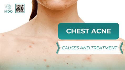 Chest Acne From Sunscreen