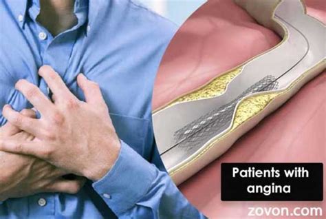chest pain after stent placement
