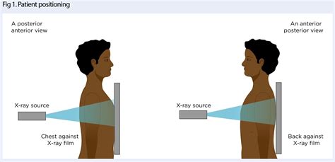 Chest X Ray Ap View Positioning