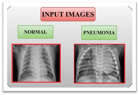 Chest X Ray Changes Pneumonia