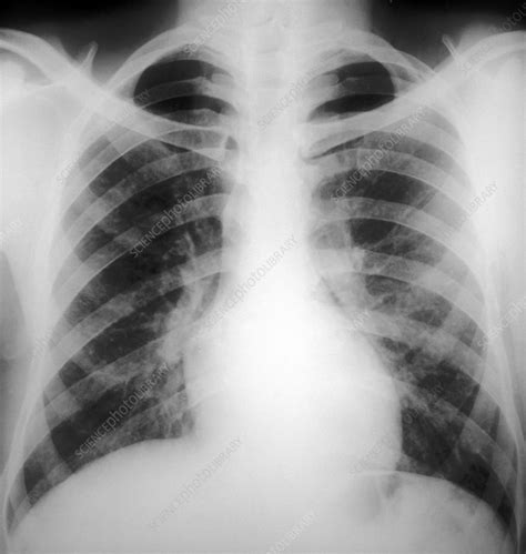 Chest X Ray Chronic Bronchitis