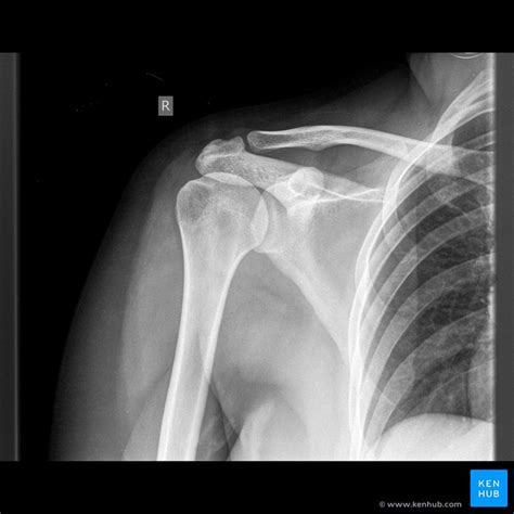 Chest X Ray Clavicle