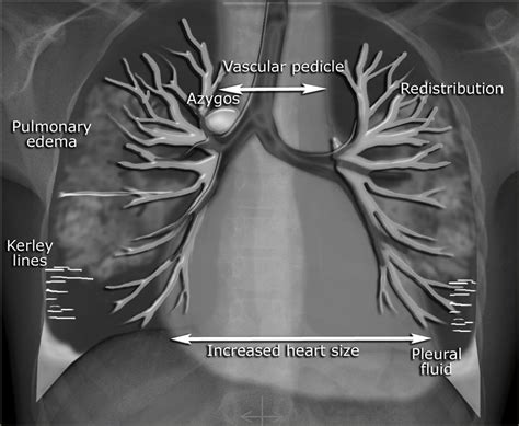 Chest X Ray Heart Failure