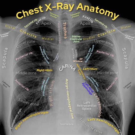 Chest X Ray Normal Labelled