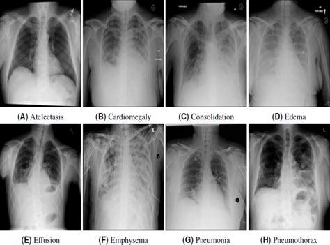 chest x ray pathologies