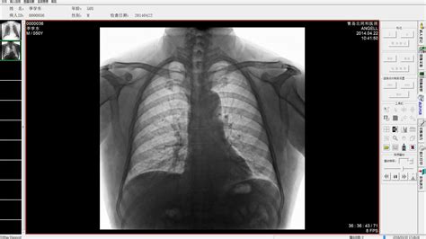 Chest X Ray Two Views With Fluoroscopy Cpt Code