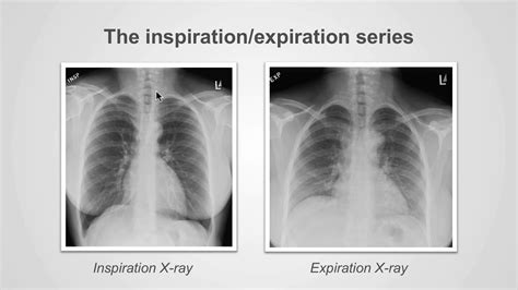 Chest X Ray Types