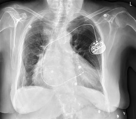 Chest X Ray With Pacemaker