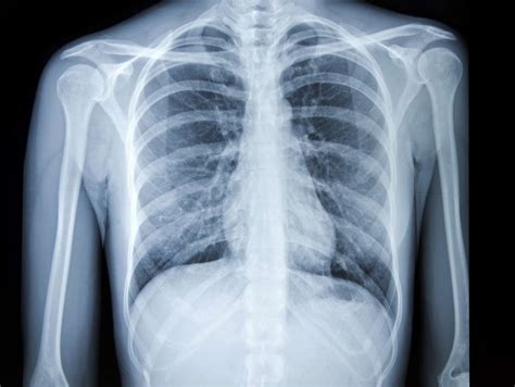 chest x-ray image