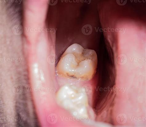 Chewing Ginger for Tooth Extraction