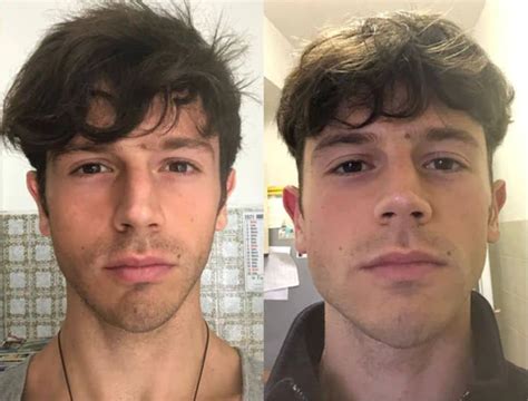 Chewing Gum Effect On Face