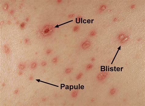 chicken pox in nepali