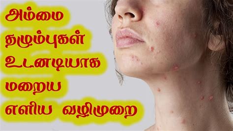 chicken pox meaning in tamil