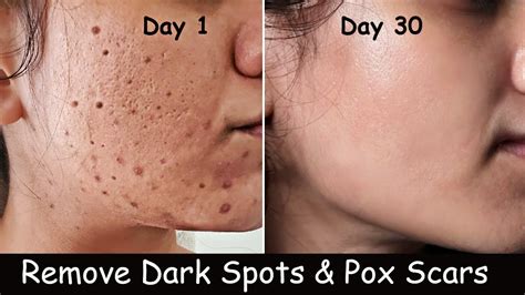 chicken pox scars on face removal