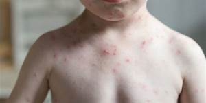 chickenpox and shingles