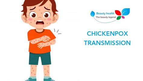 chickenpox transmission