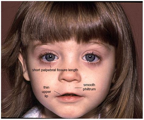 children with fetal alcohol syndrome images