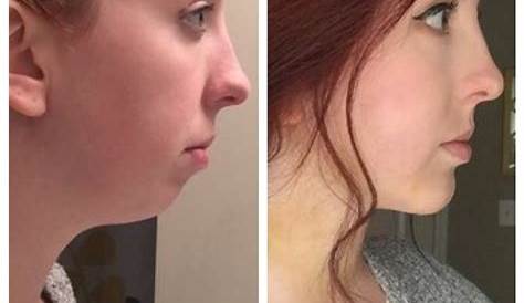Chin Augmentation Before and after photos | Sandy Springs, GA | Patient